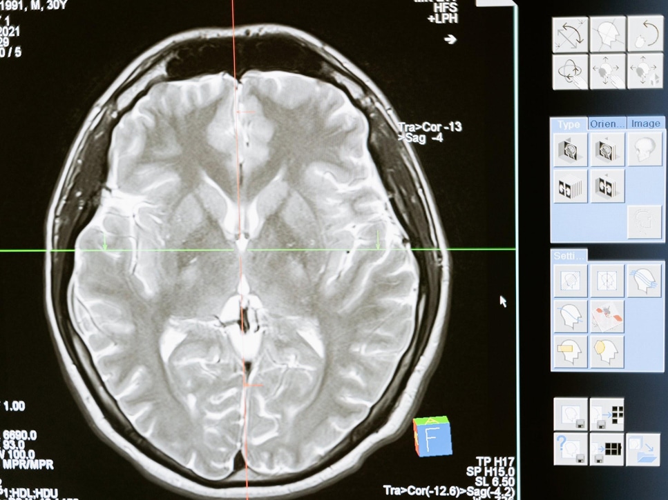 Treating-Parkinson’s-Tremors-With-Non-Invasive-Ultrasound-smpltec